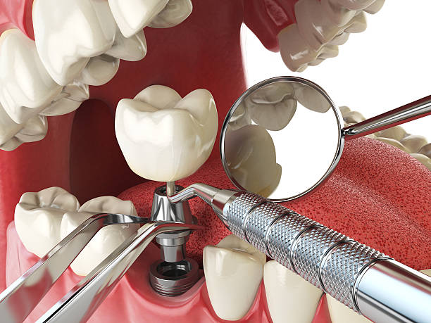Best Broken or Cracked Tooth Emergency Dentist in South Riding, VA