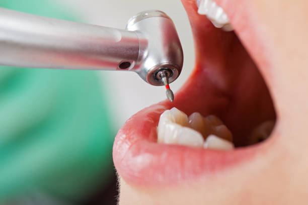 Best Emergency Root Canal Treatment in South Riding, VA